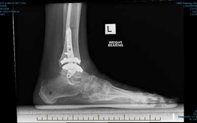 Ankle replacement updates