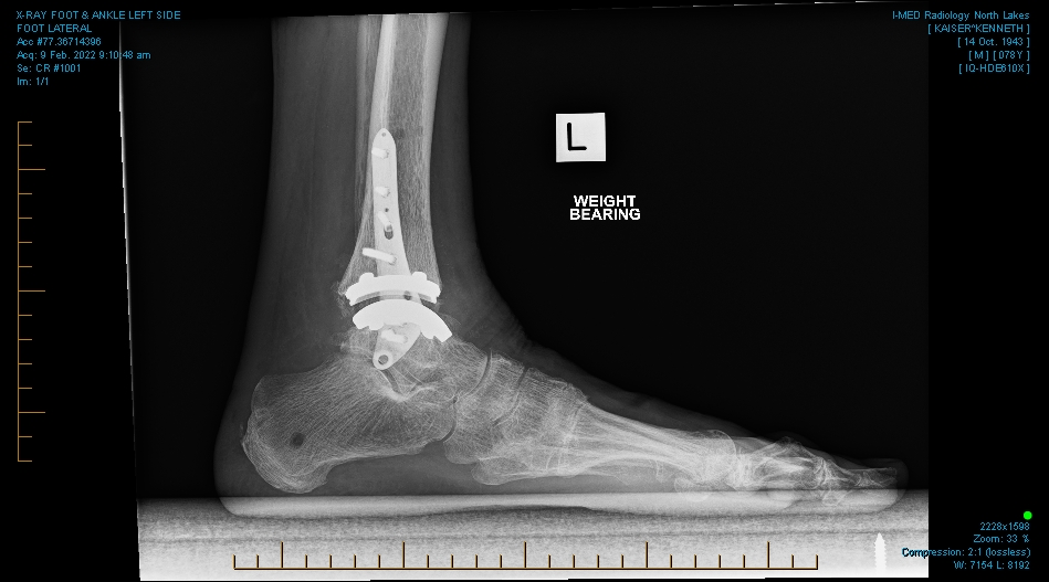 Ankle replacement updates