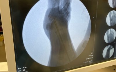 Revision Total Ankle Replacements and keyhole bunion updates